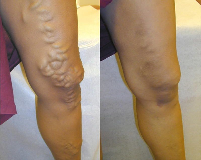 picioare crescute în varicoza tratament naturist pentru vinisoarele de pe picioare