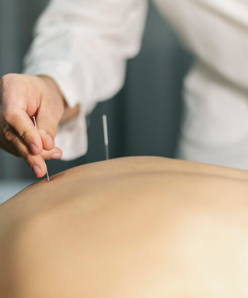 Descoperirea puterii terapeutice a acelor de acupunctură: O călătorie în medicina tradițională chineză