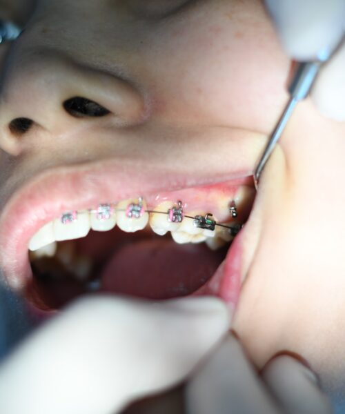 Purtarea aparatului dentar clasic – la ce să te aștepți în această perioadă?