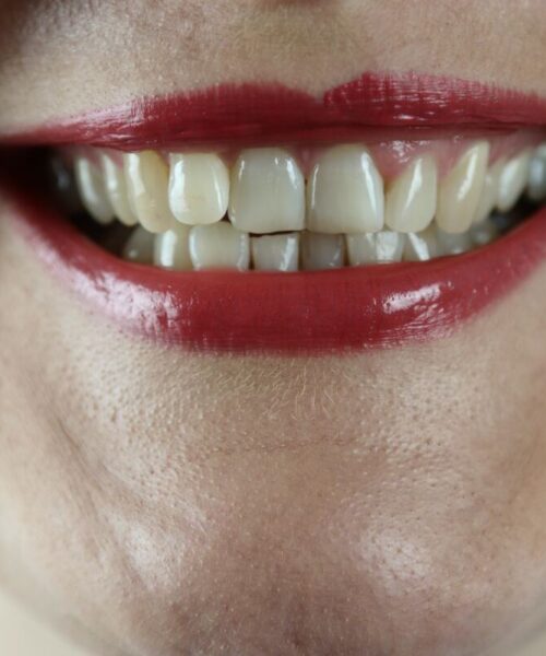 Tipurile de implanturi dentare – O privire de ansamblu asupra opțiunilor de restaurare a zâmbetului